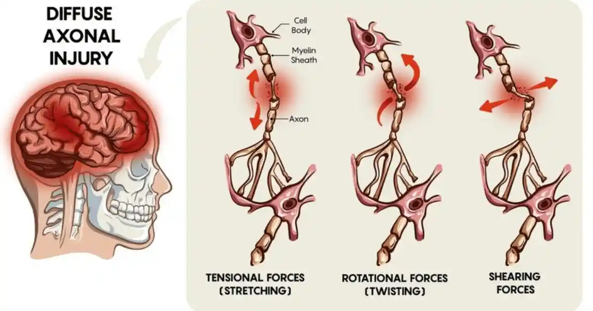 qu-es-una-lesi-n-axonal-difusa