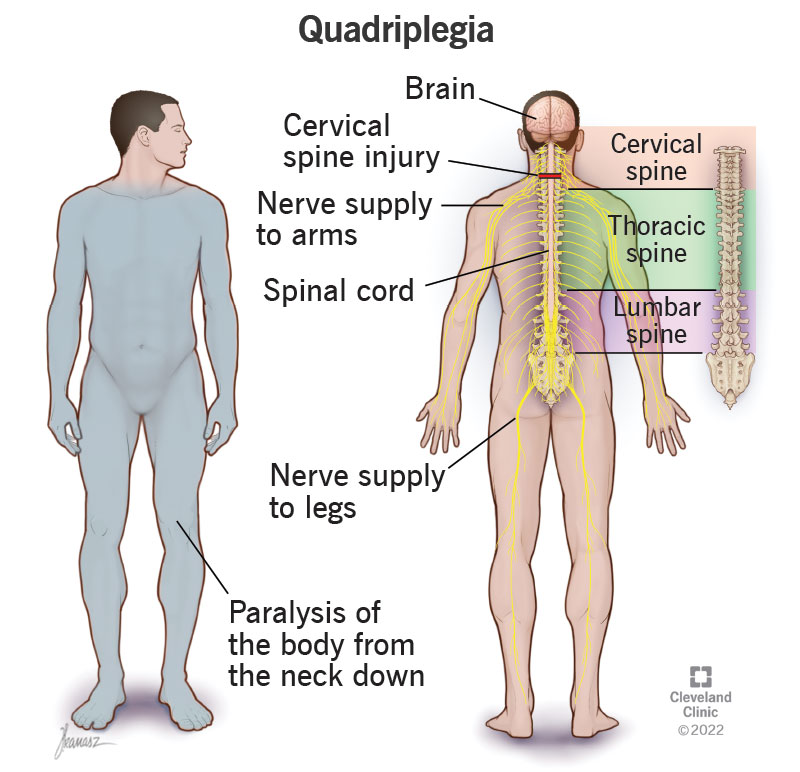 Quadriplegia Lawyers in Northern California | GJEL Attorneys 1