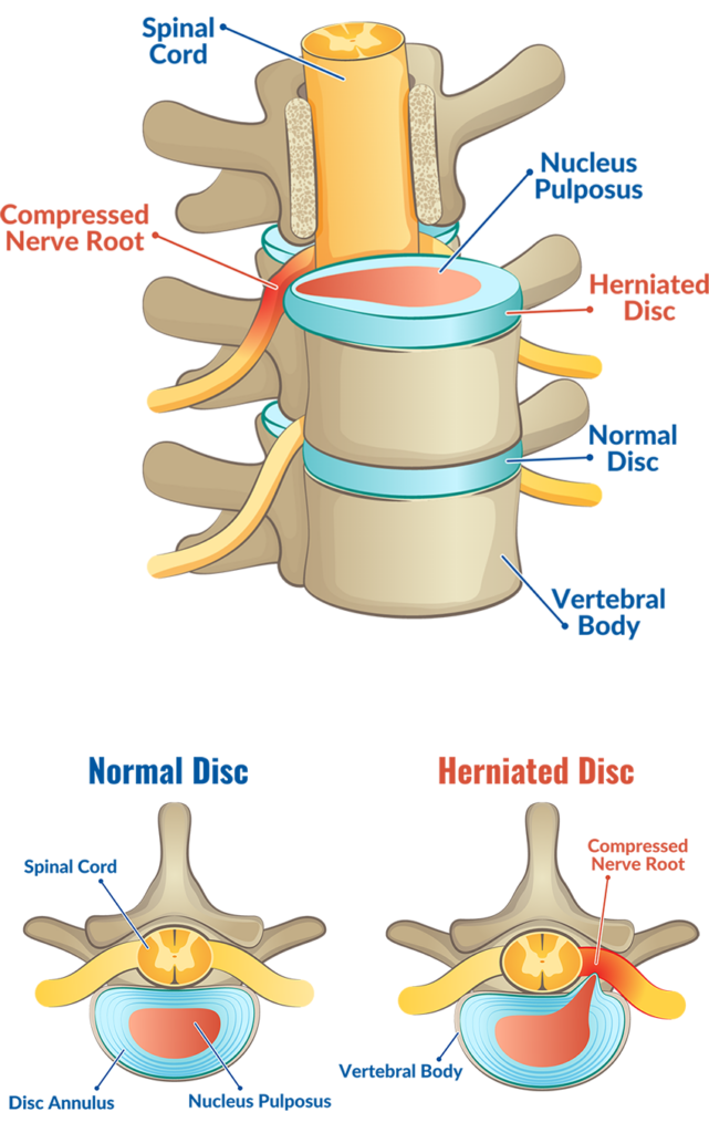 Herniated Disc Injury Lawyers in Northern California | GJEL 1