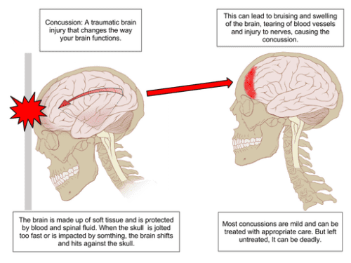 Traumatic Brain Injury (TBI): Signs, Symptoms & Causes | GJEL 1